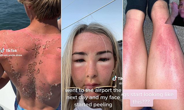 Holidaymakers reveal their sunburn horror stories
