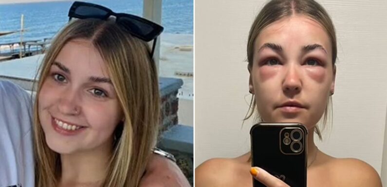 ‘I wanted cute holiday snaps — but I got hospitalised with mystery swollen face’